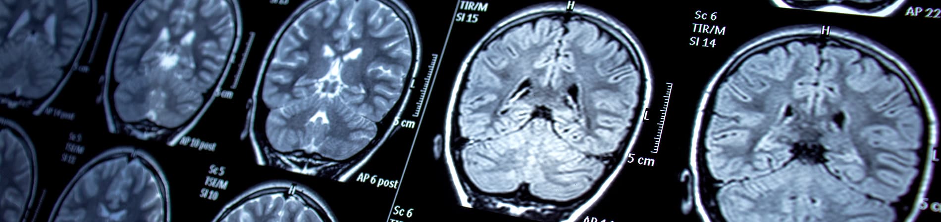 MRI brain scans for epilepsy & seizures