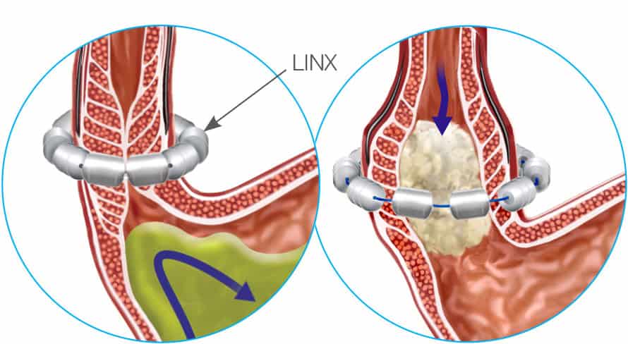 Benefits of acid reflux surgery