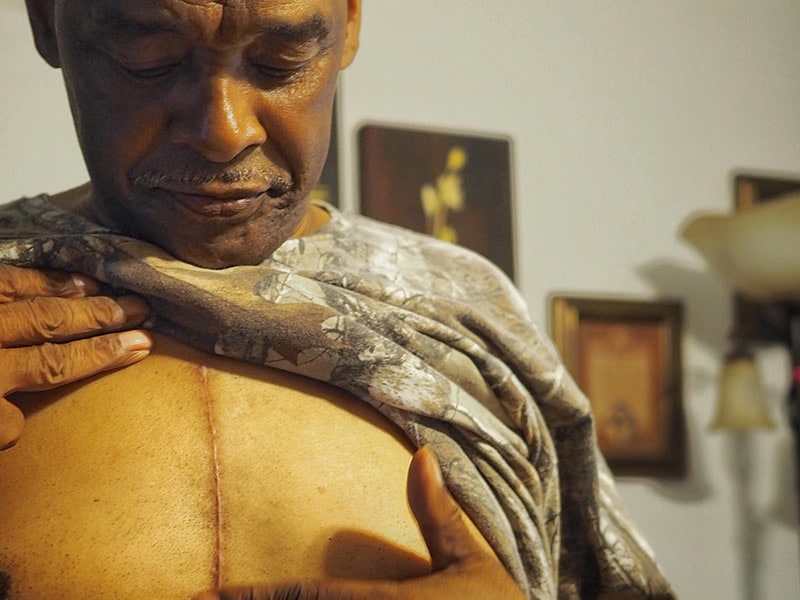 Calvin Box shows the scar from his redo-mitral valve replacement surgery.