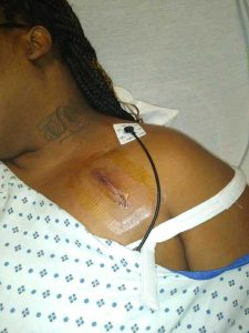 Miller’s incision following the pacemaker implant surgery