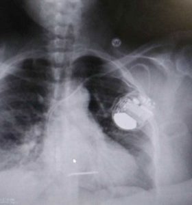 An x-ray showing the defibrillator in Miller's chest